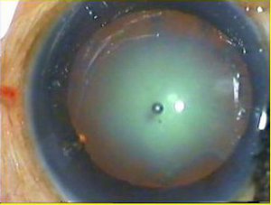 Cataract as seen through a microscope