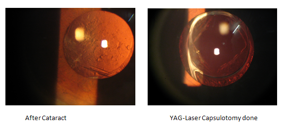 YAG Capsulotomy